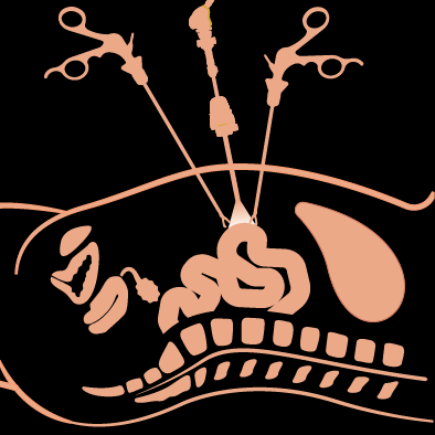 Laparoscopy Laser Clinic
