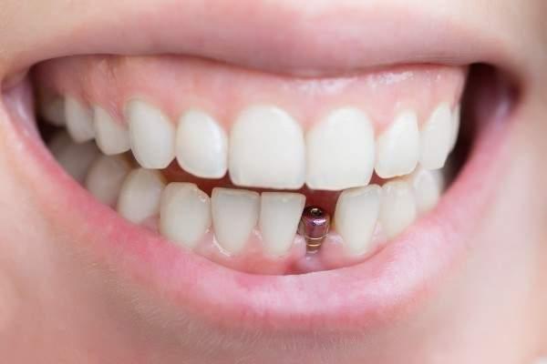  invisalign Clapham
