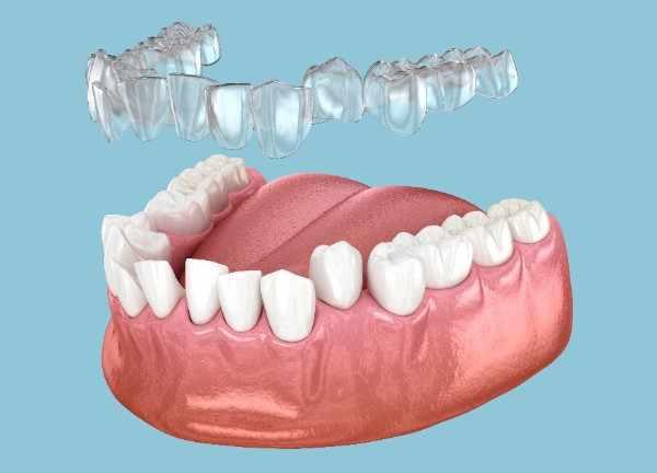  invisalign Clapham