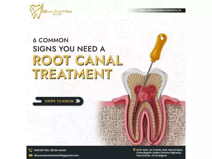 PPT - Lifecare Dental Clinic - 6 Common Signs You Need a Root Canal Treatment PowerPoint Presentation - ID:12620200