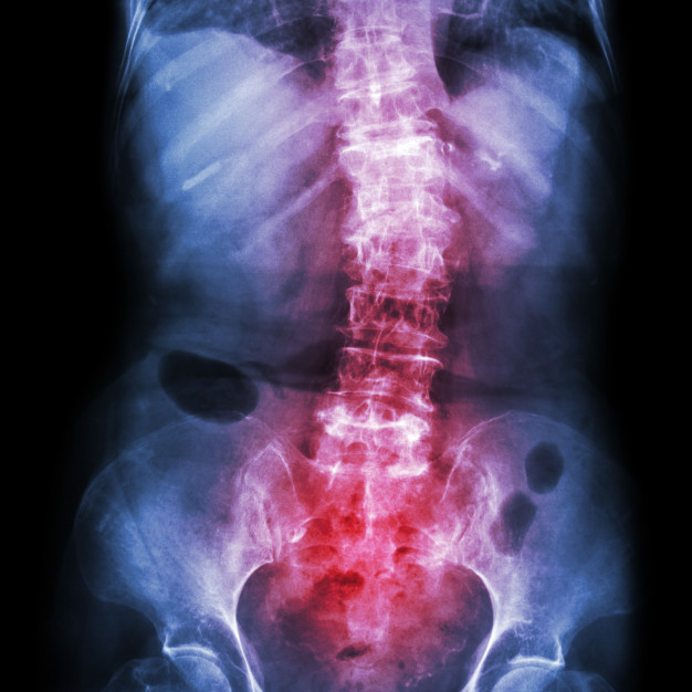 Ankylosing Spondylitis : Symptoms, Cause and Treatment Explained – Dr Sumit Badhwar