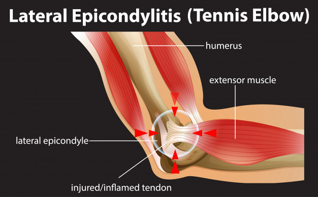Tennis Elbow : Symptoms, Causes and Treatment of this Elbow Pain Disease – Dr Sumit Badhwar