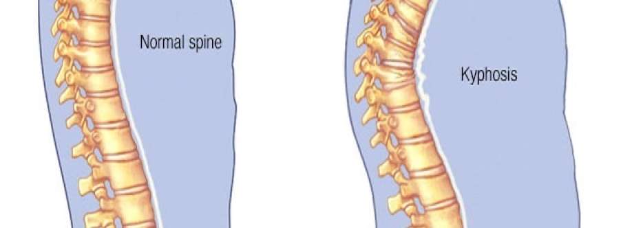 Best Spine Surgery Hospitals in India Cover Image