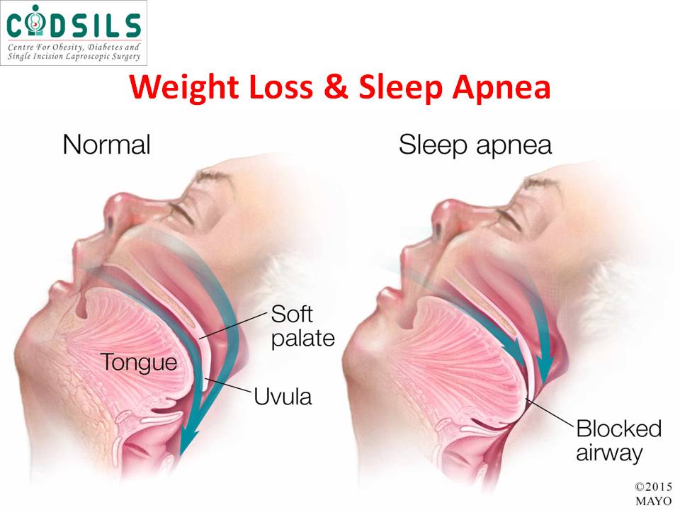 Weight Loss and Sleep Apnea | Sleep Apnea Weight Loss