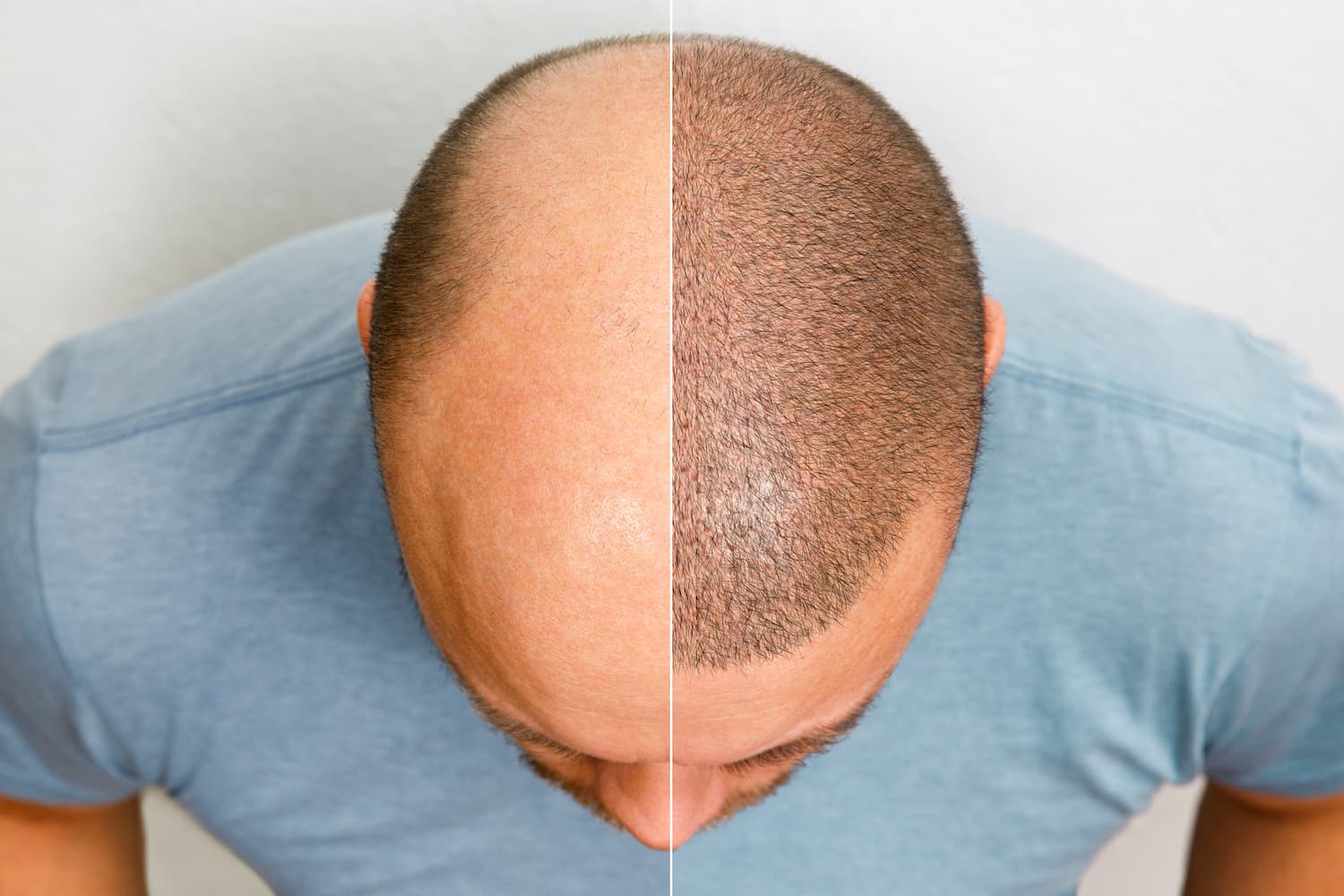 Embrace A New Era Of Confidence: Life-Changing With Hair Transplant After 10 Years