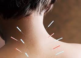 Acupuncture for back pain relief in Ottawa