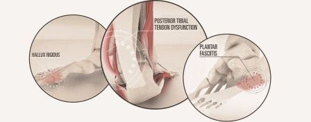 Tailored orthotics for sports injuries in Coquitlam